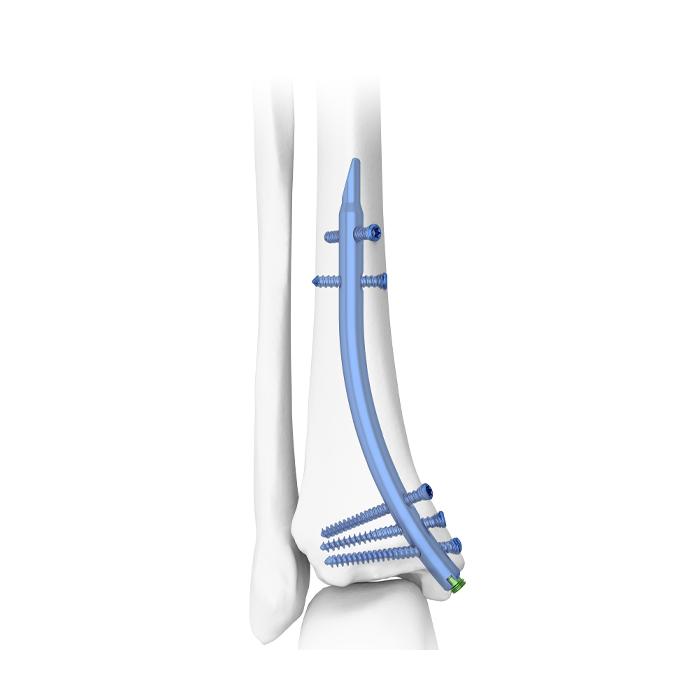 Tibial Fractures: Technique of IM Nailing : Wheeless' Textbook of  Orthopaedics