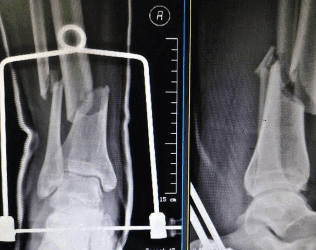 Case Share: Fracture of the Distal Tibia